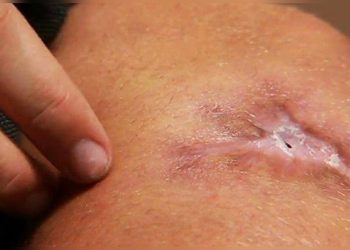 Nigeria: Flesh-Eating Disease Resurfaced In Adamawa With 23 Patients Hospitalized